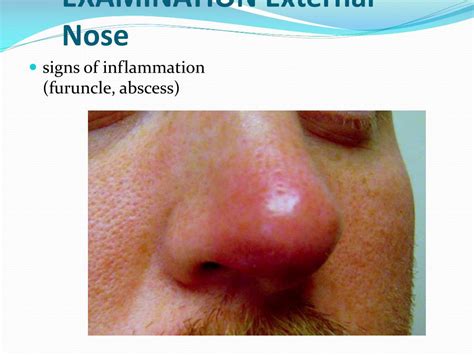 Nasal Vestibular Furunculosis Cheap Sales, Save 69% | jlcatj.gob.mx