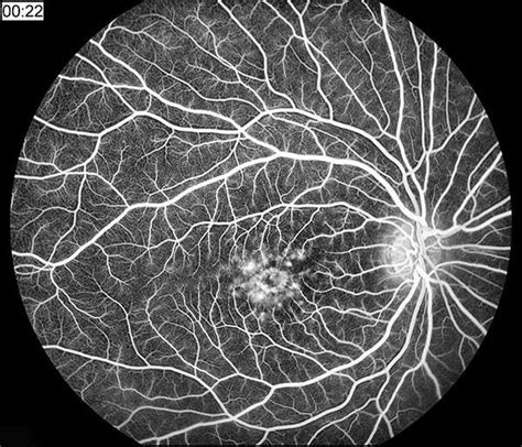 Fluorescein Angiography