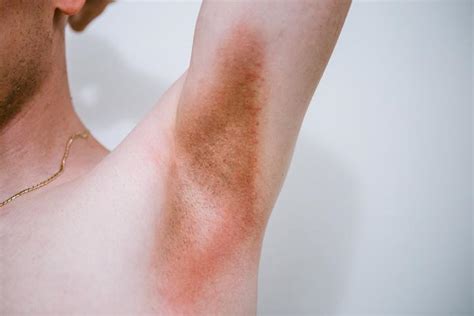 Psoriasis In Children: Symptoms, Types & How To Deal With It