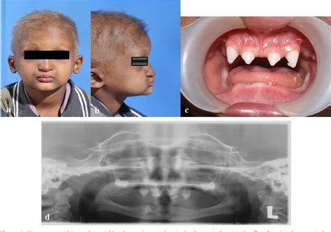 Ectodermal Dysplasia Teeth