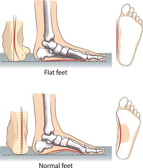 Flat Foot Surgery | BJIOS Orthopaedics