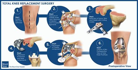 Total knee replacement, Knee replacement exercises, Knee replacement surgery