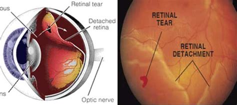 A minimally invasive treatment for retinal detachment gives patients sharper vision, less ...