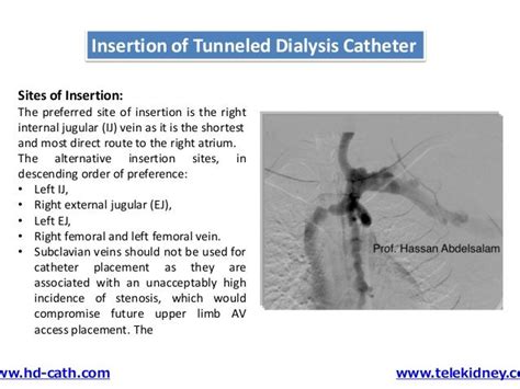 Tunneled Catheter Advantages