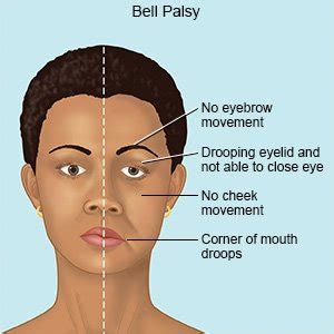 Bell Palsy - What You Need to Know