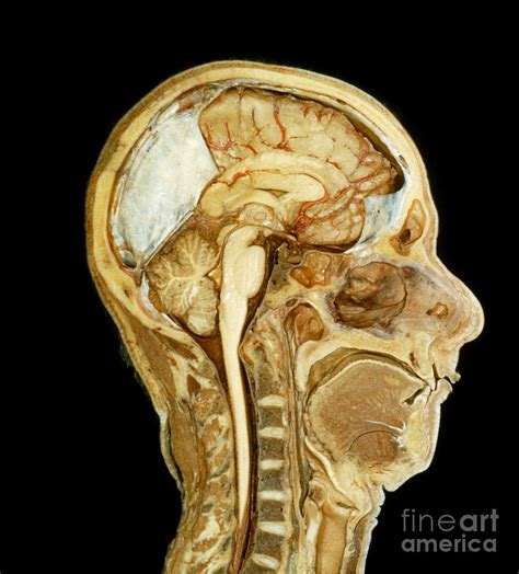 Midsagittal Section Of The Brain Color Coded