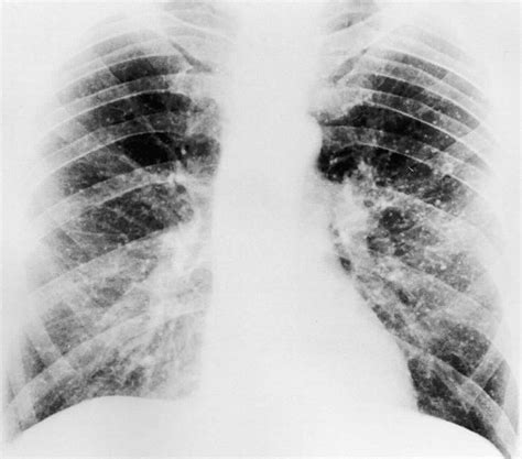 Calcification definition & calcification in arteries, heart, lungs, breast, kidney & brain