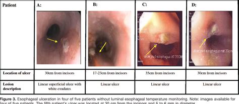 Ulcer of esophagus | Semantic Scholar