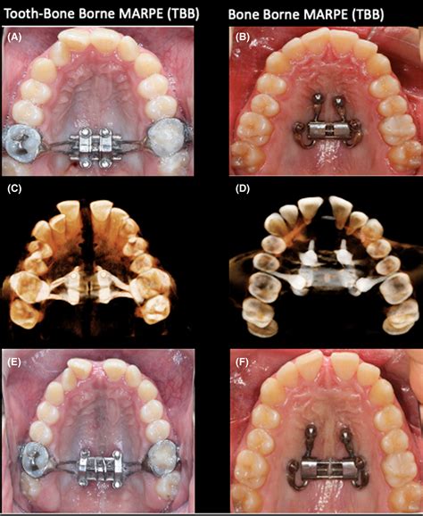 Rapid Palatal Expander Types | edu.svet.gob.gt