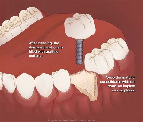 Bone Graft - Vancouver, BC - Enlighten Dental - Dental Implants