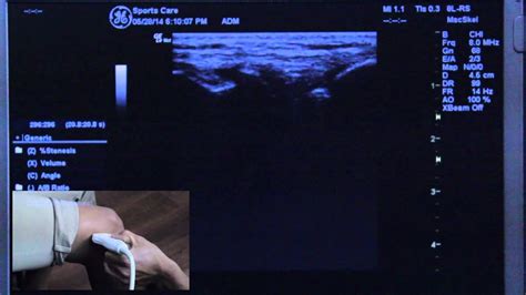 MSK Ultrasound Knee Diagnosis - Orange County, Huntington Beach - YouTube