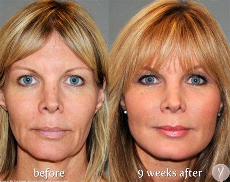 Pin on NIP & TUCK: Facelift (Rhytidectomy)