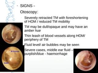 Secretory otitis media | PPT