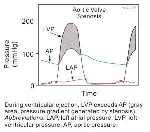 Aortic Valve Gradient - For Patients with Aortic Stenosis