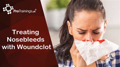 Treating Nosebleeds with Woundclot | Woundclot™ and Bleeding Online Training Video | WoundClot ...