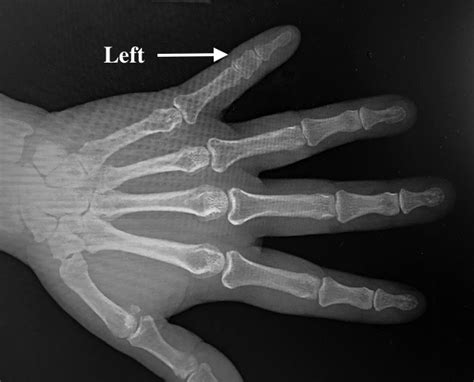 BRACHYDACTYLY | Hand Surgery Source