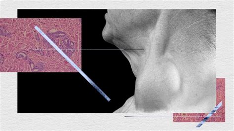 Branchial cleft cyst: Types, symptoms and treatment