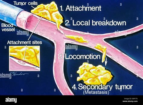 Metastasis hi-res stock photography and images - Alamy