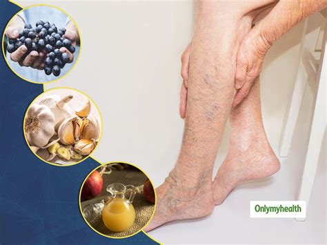 Here Are Some Natural Home Remedies To Get Rid Of Varicose Veins ...