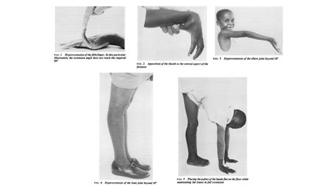 beighton scale chart Beighton score syndrome danlos ehlers hypermobility system marfan scale eds ...