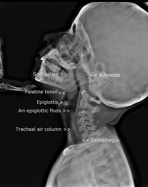 Enlarged Tonsils Neck