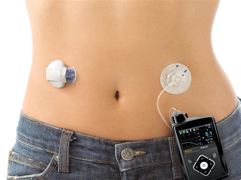 Insulin Pump Therapy: How It Works, Advantages & Disadvantages ...