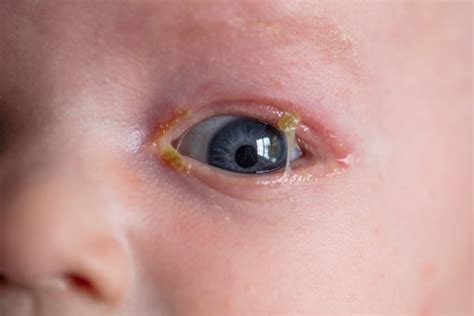 Pink Eye: Causes And How to Treat It - Food Storage Moms