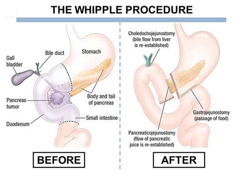 Whipple procedure steps, indications, complications, recovery & survival rate