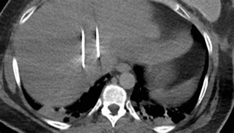 Ready, Aim, Ablate: Liver Ablation Procedure Techniques | BackTable