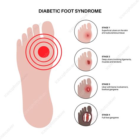 Diabetic foot ulcers, illustration - Stock Image - F042/1342 - Science ...