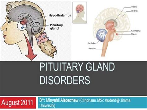 PITUITARY GLAND DISORDERS |authorSTREAM