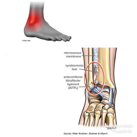 Ankle Syndesmosis | Jonathan Collier Injury Rehabilitation