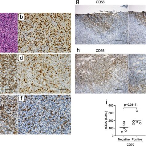 Expression of CD27 and CD70 in ENKL biopsy tissues. Representative ...