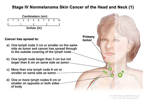 Skin Cancer Treatment (PDQ®)–Patient Version - Siteman Cancer Center