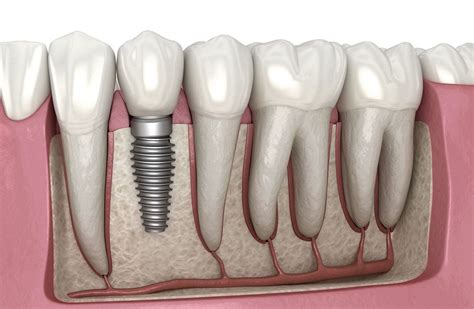 All On 4 Dental Implants Near Me