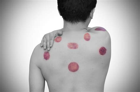 What do Cupping Marks mean on the Body – Lierre.ca