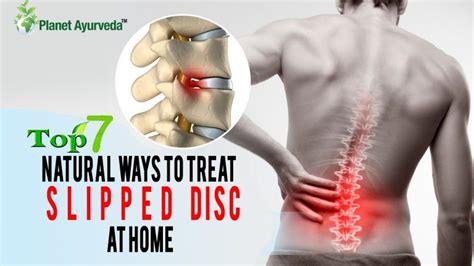 Treat Slipped Disc | Bulging disc, Slipped disc exercises, Disc