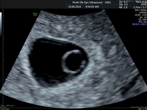 Early pregnancy scan gallery - POGU