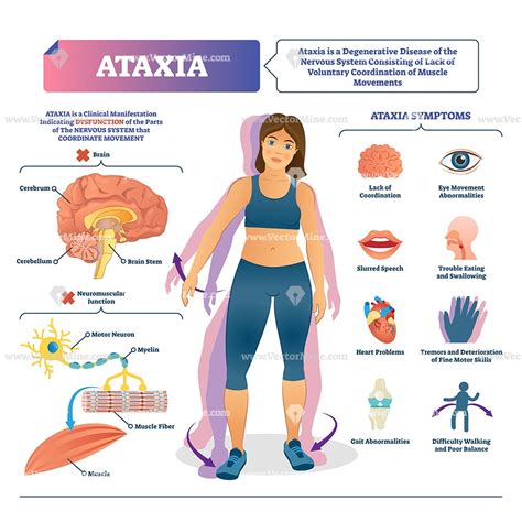 Ataxia disease medical vector illustration infographic | Ejercicio fisico y salud, Fisioterapia ...