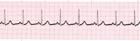 Normal Sinus Rhythm training - video | ProCPR