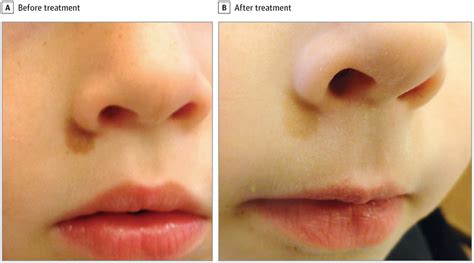 Response to Laser Treatment of Café au Lait Macules Based on Morphologic Features | Physical ...