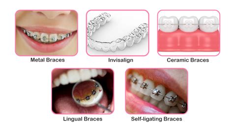 Types of Dental Braces - Lansdowne, VA Family Dentistry