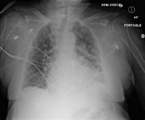 Pulmonary Congestion Chest X Ray