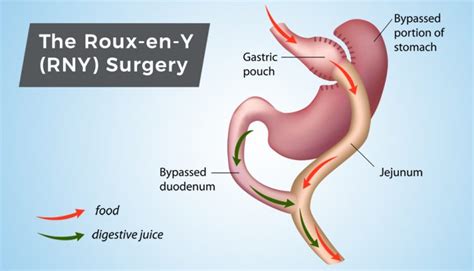 Gastric Bypass Surgery: Yesterday and Today : ObesityHelp