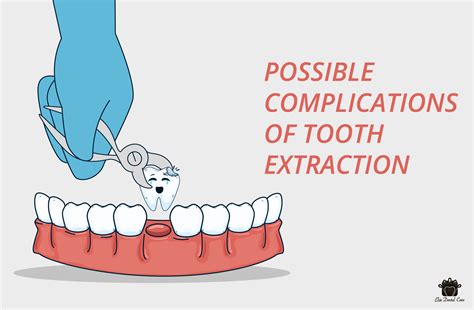 Possible Complications of Tooth Extraction - Elite Dental Care Tracy ...