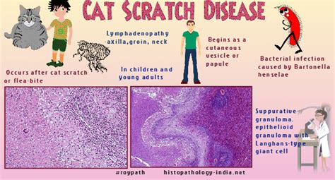 Cat Scratch Disease Neck