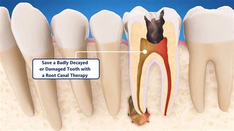 Save a Badly Decayed or Damaged Tooth with a Root Canal Therapy | Root canal treatment, Root ...