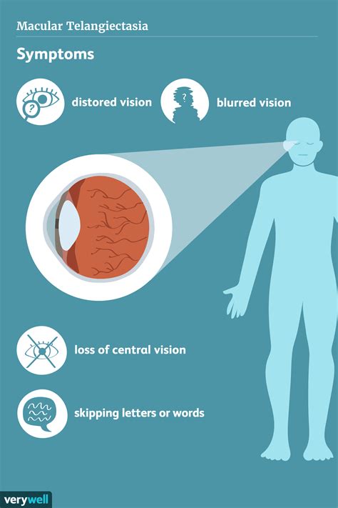 Macular Telangiectasia: Types, Symptoms, Diagnosis, Treatment