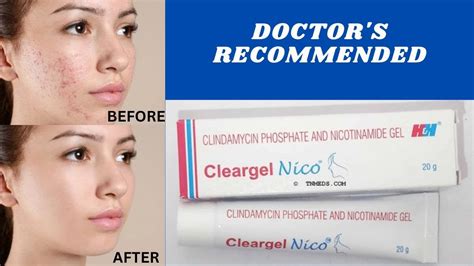 Clear Gel Review | Remove Acne, Pimples, Scars, Pigmentation, Dark Spot | Clear Gel How To Use ...