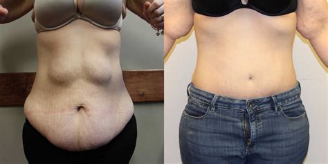 The Best What Is Mini Tummy Tuck Before And After Photos 2022 - inspireya